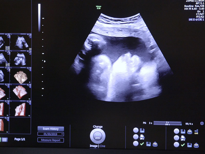 ultrasound picture of an unplanned pregnancy